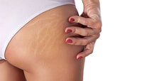 Vergeture & Cellulite image